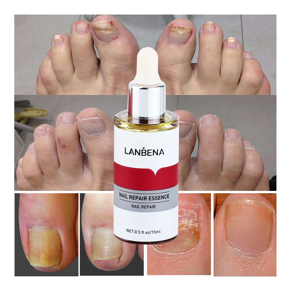 LANBENA 15ml Nail Repair Essence Serum Anti Infection Paronychia Onychomycosis Treatment Foot Care Nail Fungus Removal Gel