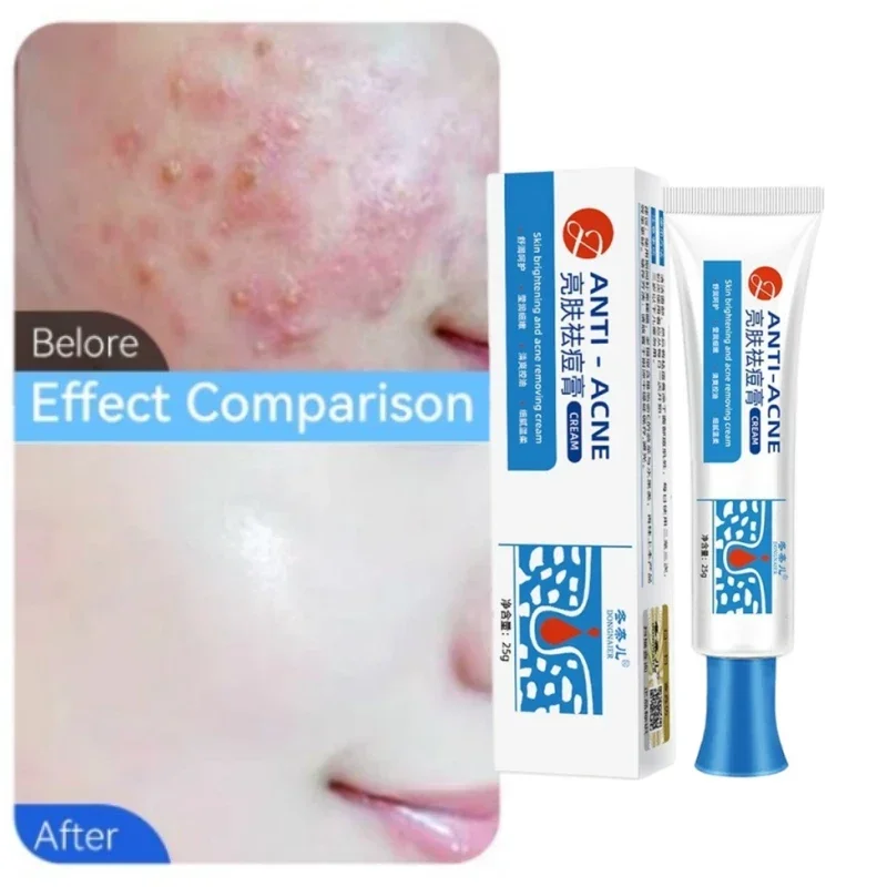 Acne Removing Cream Acne Treatment Cream Repair Pimple Spots Deep Cleaning Pore Shrinking Anti-acne Oil Control Moisturizer Skin