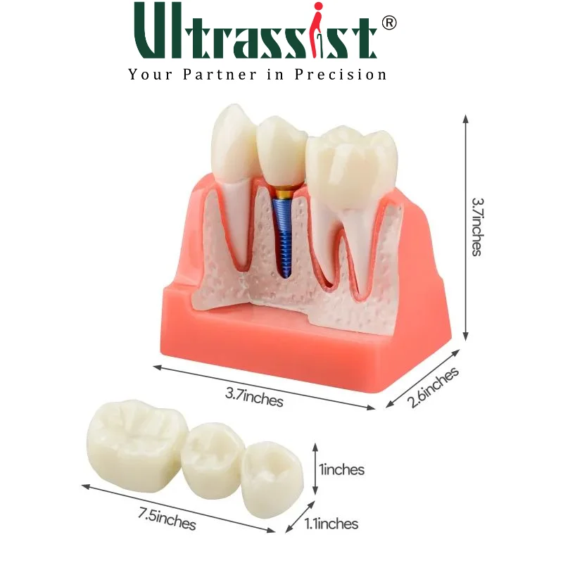 Ultrassist Dental Implant Model for Patient Education, 4 Times Dental Implant, Crown and Bridge Model for Presentation-Pink