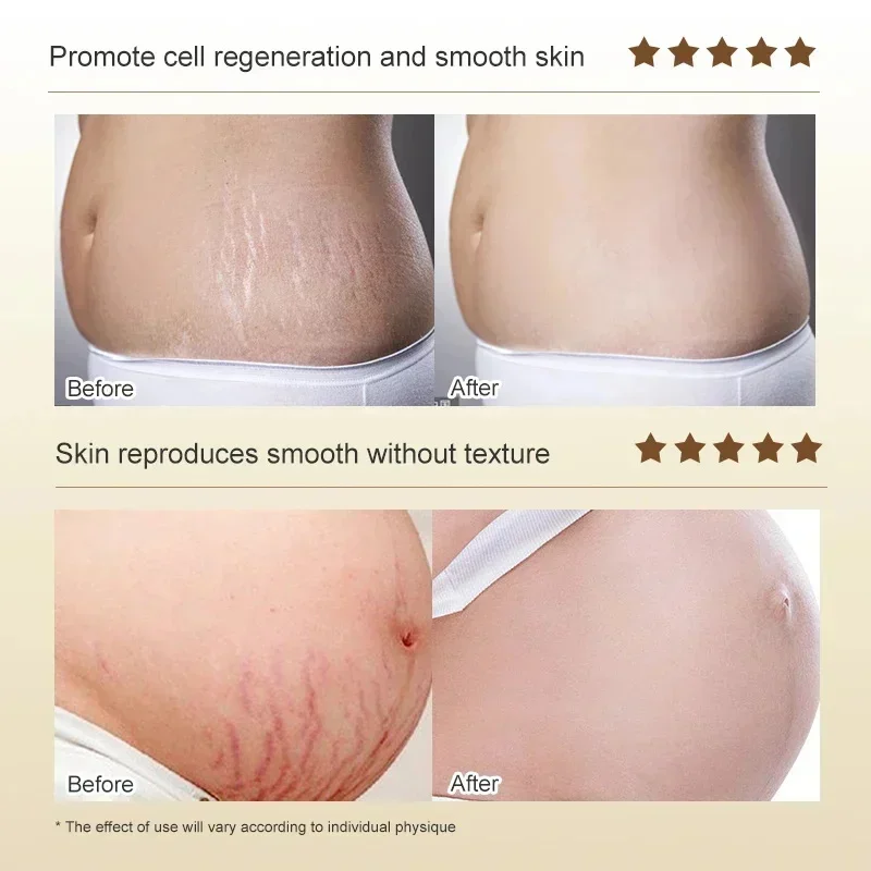 Stretch Mark Removal Cream Permanently Removes Stretch Marks Rejuvenates Skin