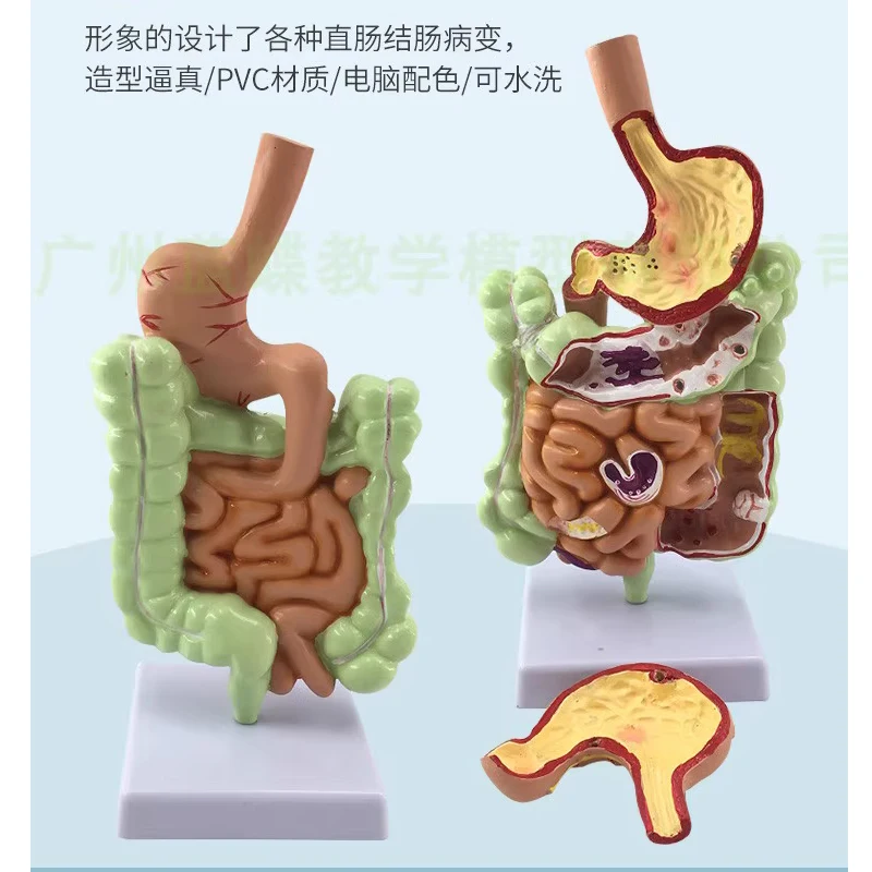 Large intestine pathological model, large intestine model, large intestine lesion model, intestinal disease, human colon lesion