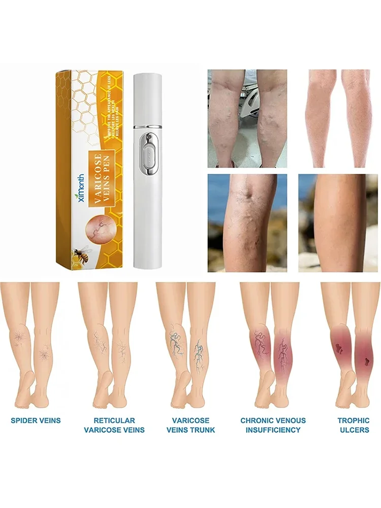 Laser Varicose Veins Pain Improves Circulation