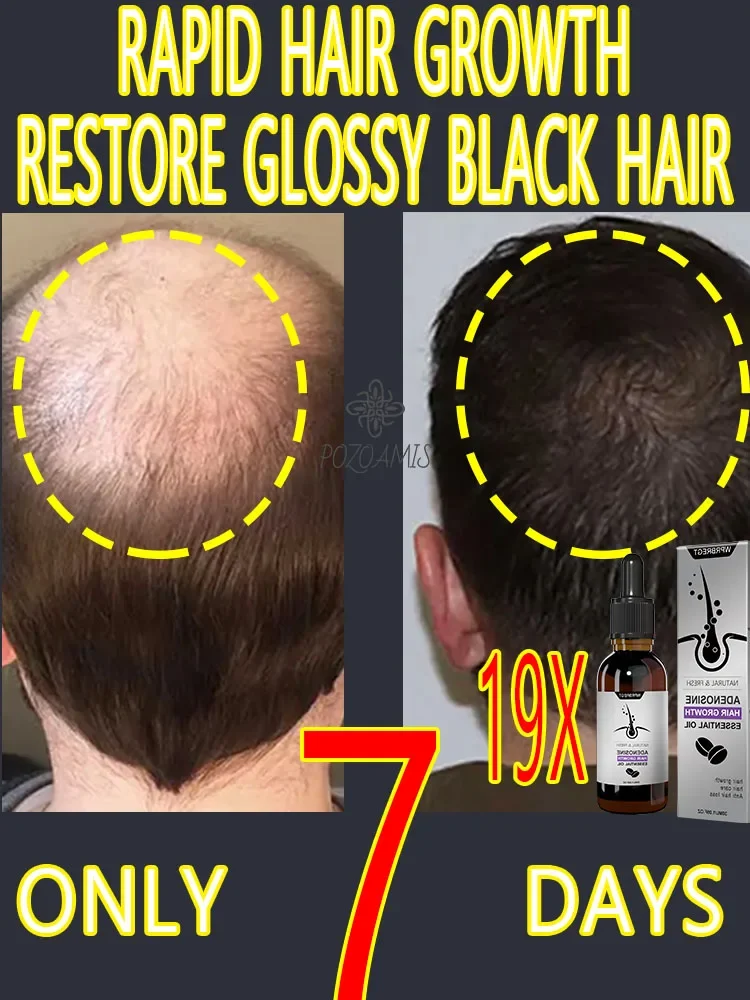 

Rapid hair growth products that can effectively repair baldness and hair loss in 2024