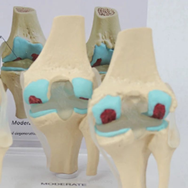 골관절염 해부학 모델 무릎 키트, 교육 키 카드 포함, 4 단계 무릎 모델, 정형 외과 교육 보조