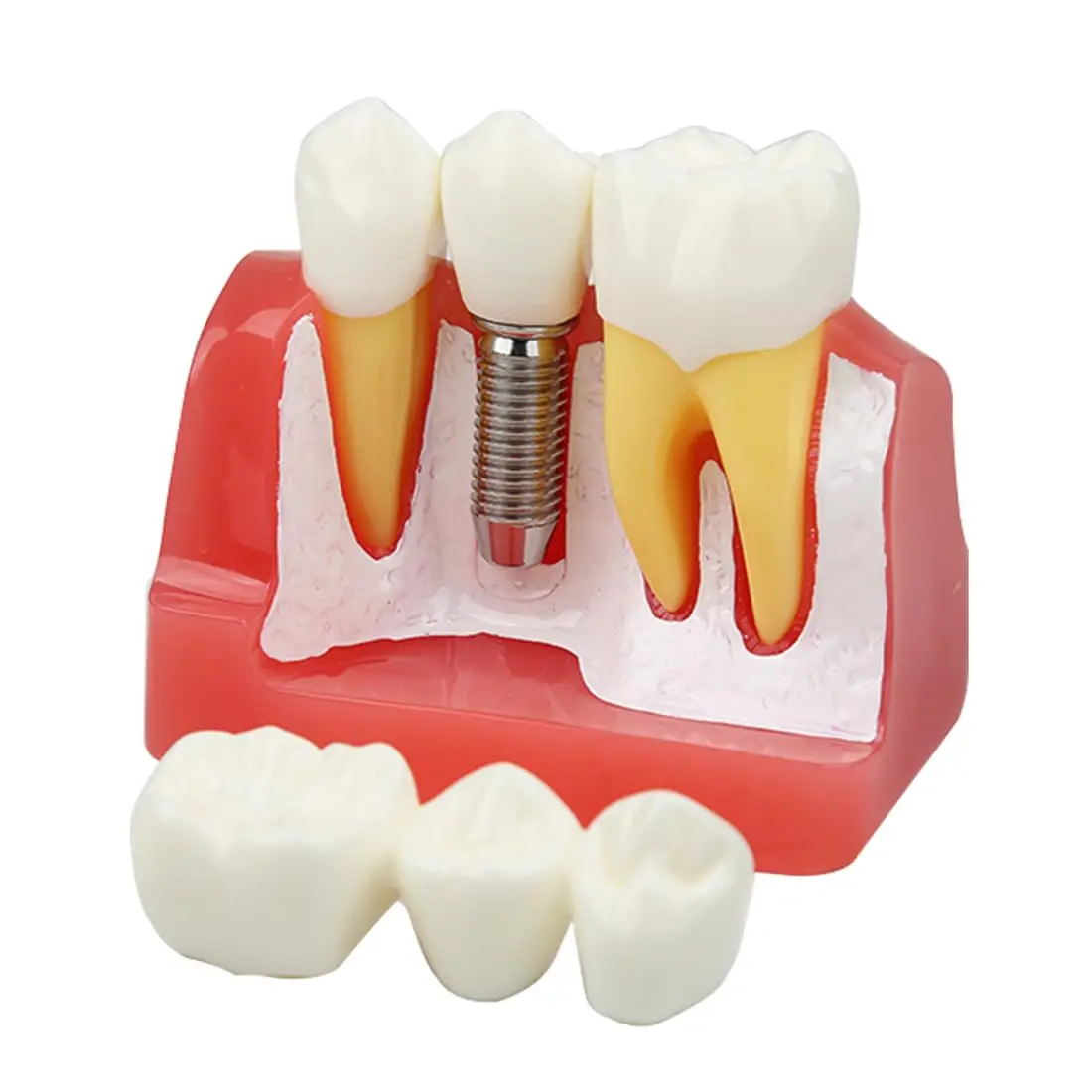 Image 6: Modèle d'implant dentaire AG, pont de couronne amovible, modèle de démonstration de dents 4 fois pour l'enseignement, l'éducation des patients