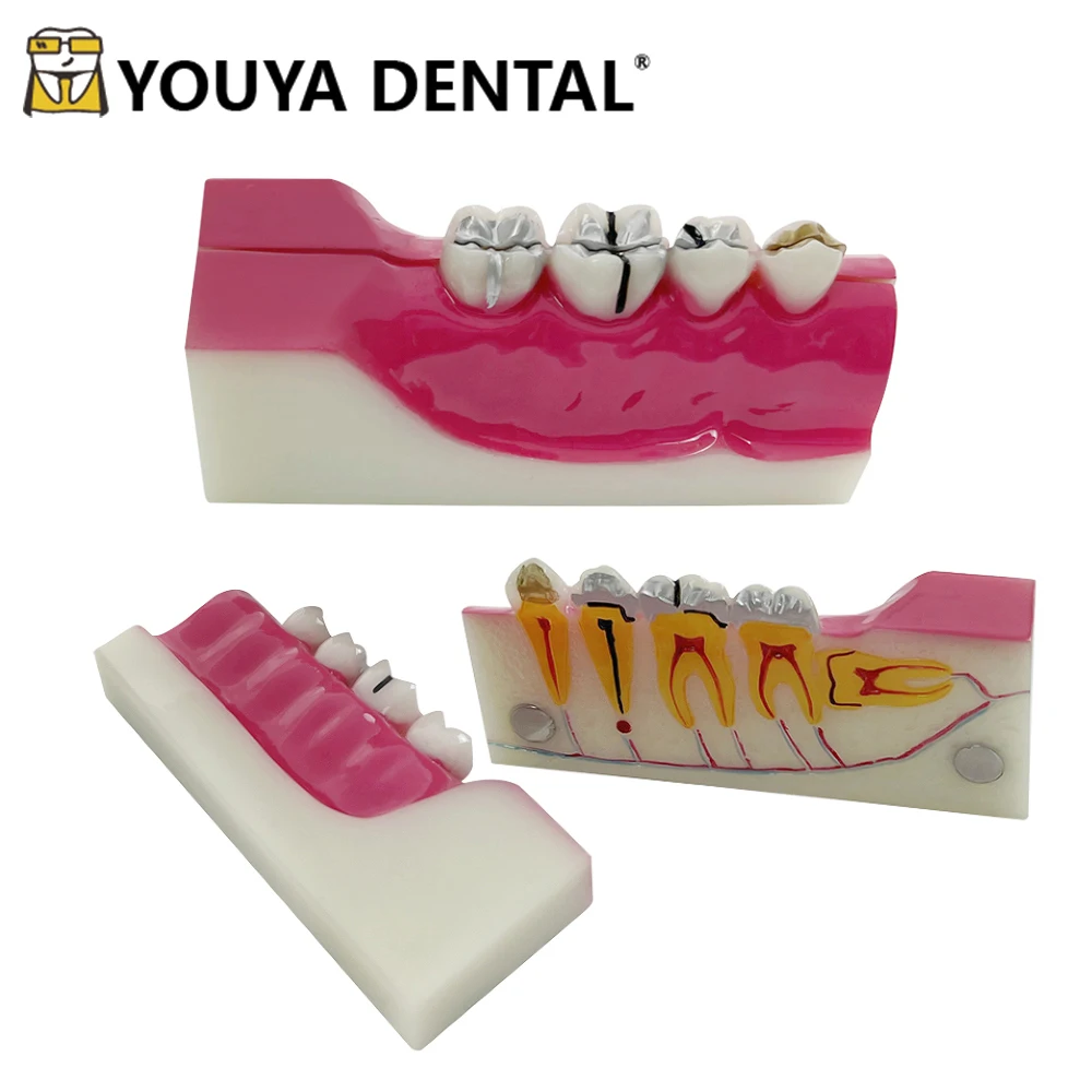 Oral Teeth Model Human Teeth Anatomy Model Anatomical Teeth Model Medical Decomposition Models Dentist Teaching Supplies