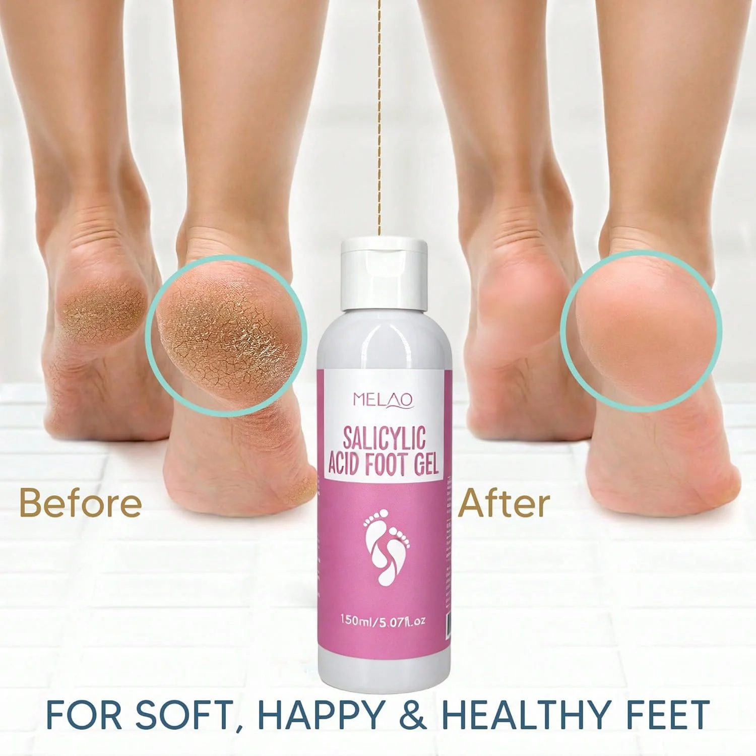MELAO Salicylic Acid Foot Gel - Dead Skin & Callus Remover, Exfoliating Treatment for Rough Cracked Feet, Softens Heels, 150ml view 6