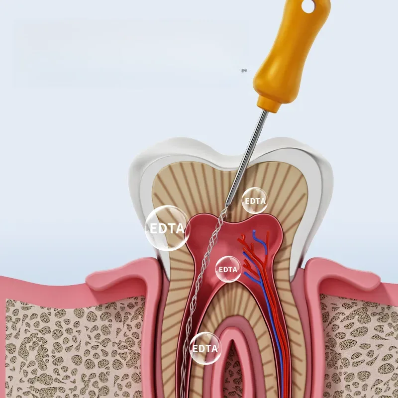 طب الأسنان EDTA 19% جل قناة الجذر 6 جرام/القطعة لتكبير القناة، ينعم دانتين، إزالة طبقة المسحة والري، اللبية