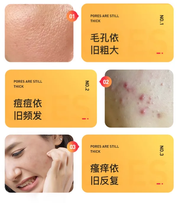 Gratis Verzending Huishoudelijke Gezichtsmijten Instrument Ozon Acne Verwijdering Acne Markeringen Acne Ontstekingsremmende Lichtvlek Schoonheid