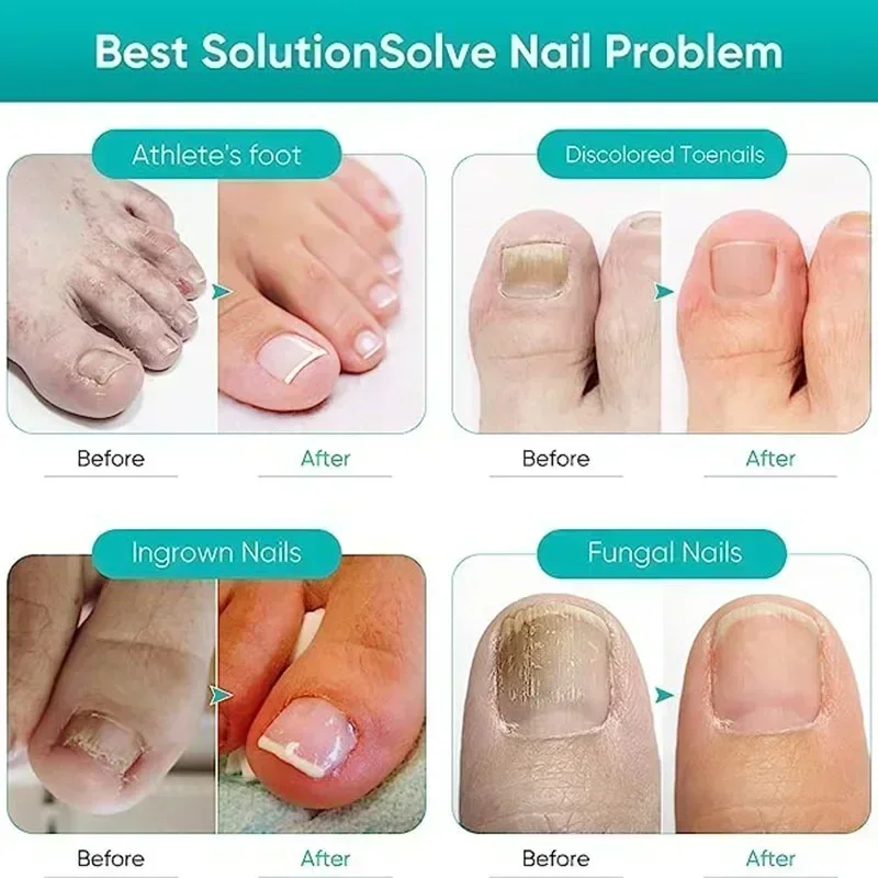 Toenail Nail Fungus Treatment Repair Fingernail Device Toenail Treatment for Foot Nail Fungus Essential Oil Onychomycosis Care