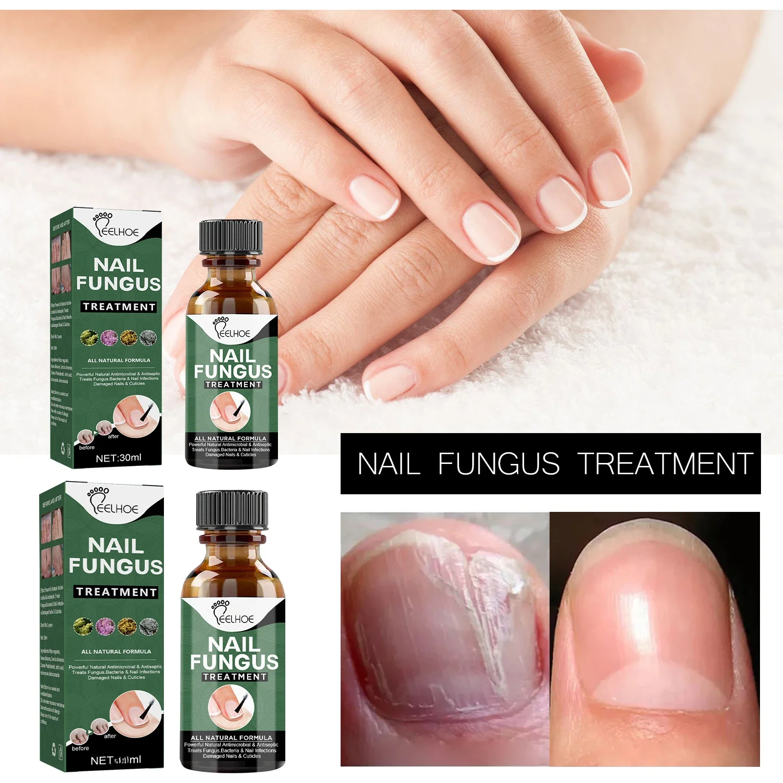 Sdotter New Nail Fungus Treatment Essence Oil Toe Nails fungal Removal Paronychia liquid Repair Gel Hand And Foot Anti-Infective