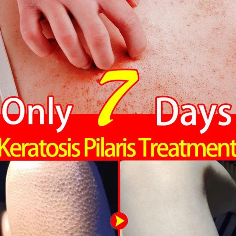 Crema de Queratosis Pilaris para eliminación de piernas de fresa, borrador de golpes KP, exfoliante corporal, elimina la piel de pollo, mejora el producto de cuidado suave