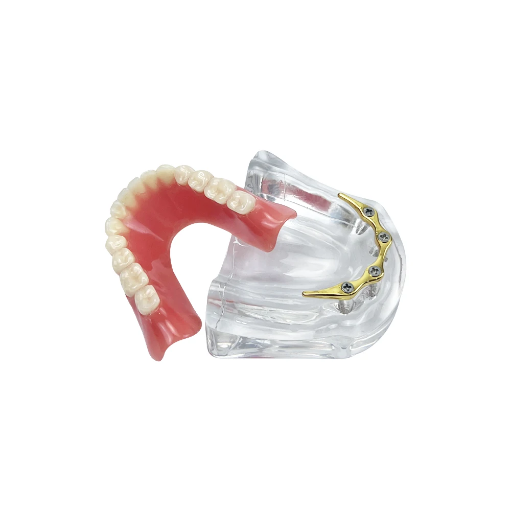 Submaxillary Dental Implant Teeth Model Restoration Bridge Removable Transparent Mandible Overdenture Model For Teaching Display
