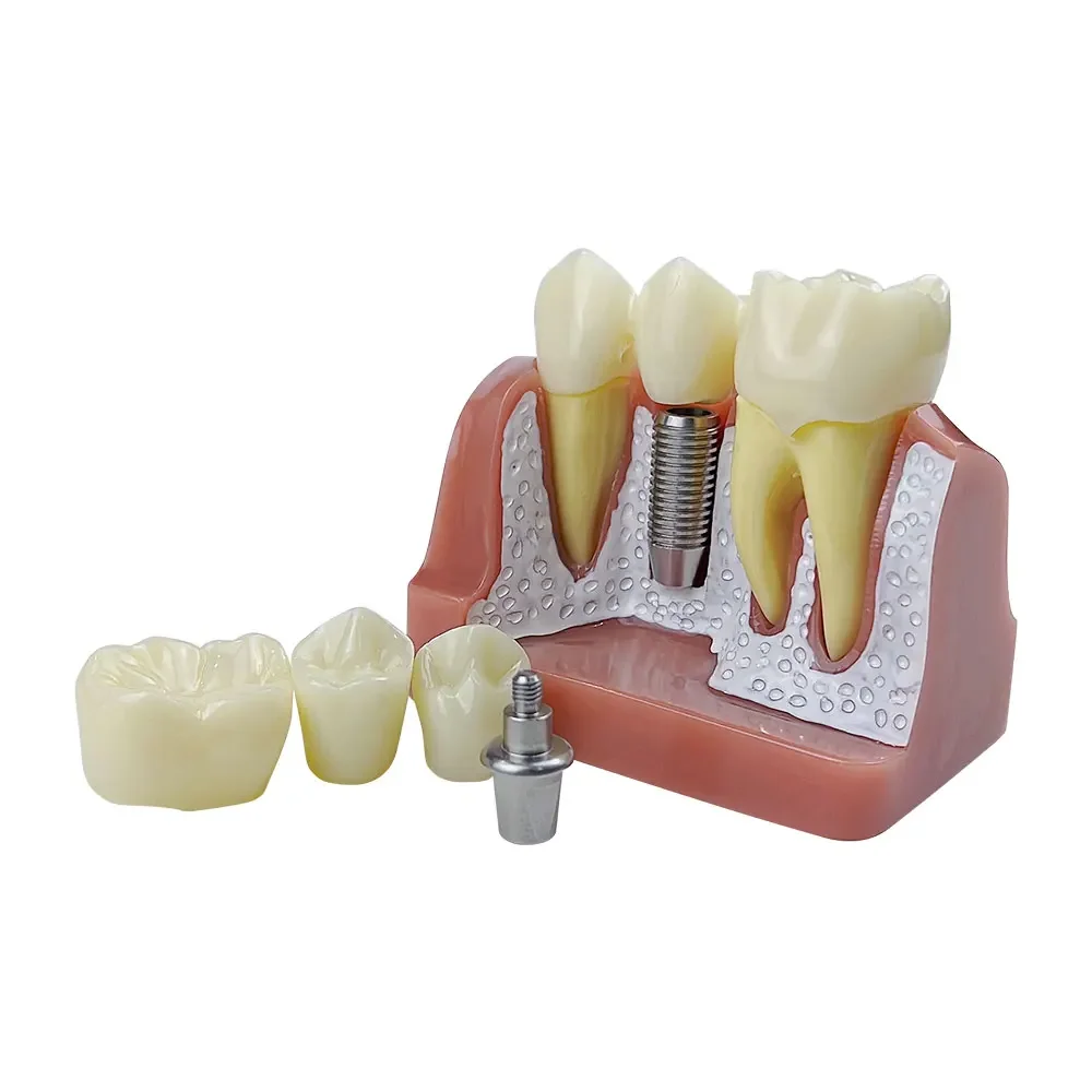 Dental Implant Teeth model Analysis Crown Bridge Demonstration Removable Model Dentisty Study Training Teaching Model