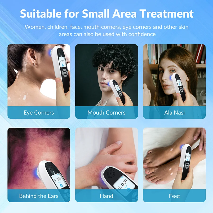 

2026 308nm Excimer Laser Uv Light Lamp Skin Curing System 6 Diodes for Vitiligo Psoriasis Eczema Treatment in a Fast Way