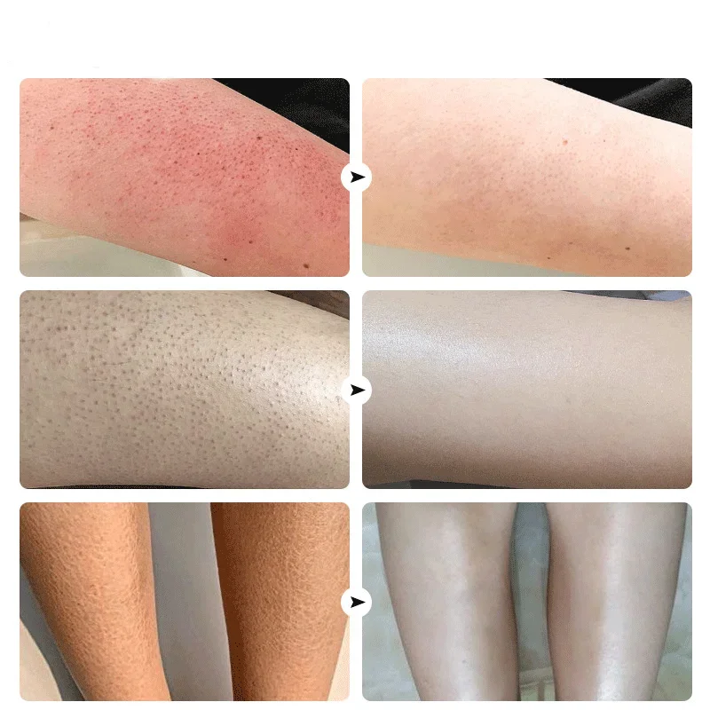 Crema exfoliante corporal rápida de 7 días, reparación de la piel hidratante, queratosis Pilaris, eliminación de fresas, borrador de piernas,