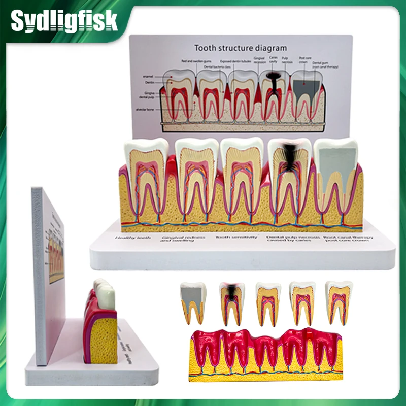 

Dental Tooth Structure Anatomical Standard Teeth Model For Teaching Studying Practice Doctor-patient Demonstration Model Dentist