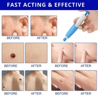2 In1 Painless Auto Skin Tag Mole Wart Removal Kit Cleaning Tools Face Skin Care Body Wart Dot Treatments Remover Beauty Health 5