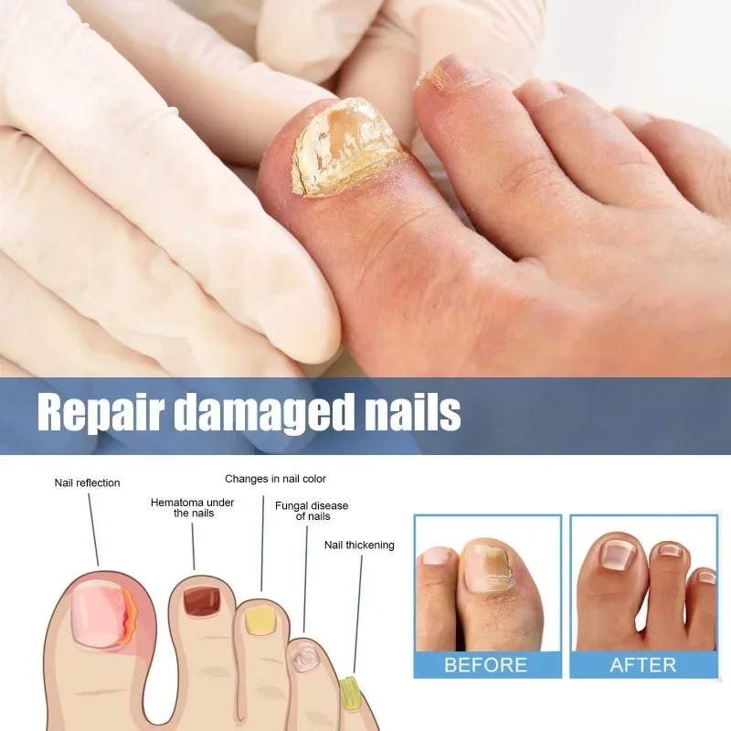 10 Sheet Extra Strength Nail Repair Patches Fast Effective Toenail Damaged Discolored Brittle Nails Renewal Fingernails Sticker