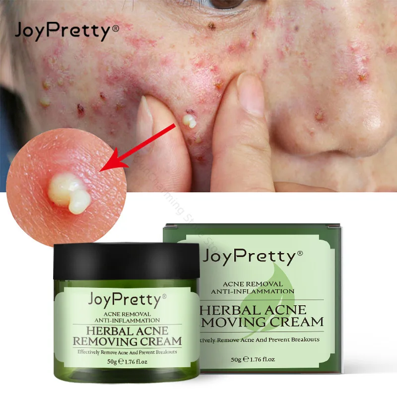 JoyPretty-с травами против акне creme facial, espinhas marcas remoция, контроль масла, hidratante Pockmark, cremes facais suaves