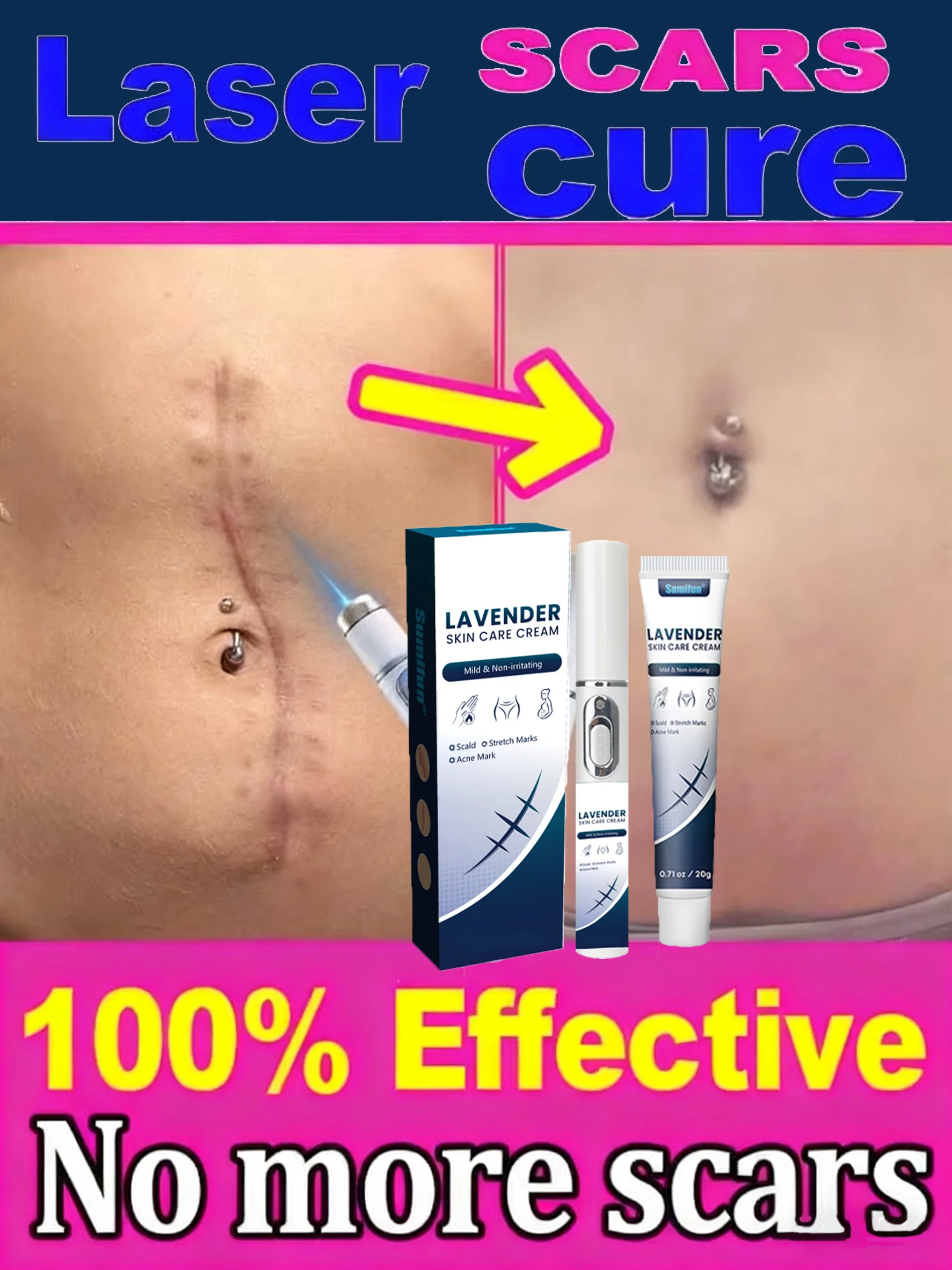 

Восстановление растяжек при беременности: быстрые результаты на лазерную ручку