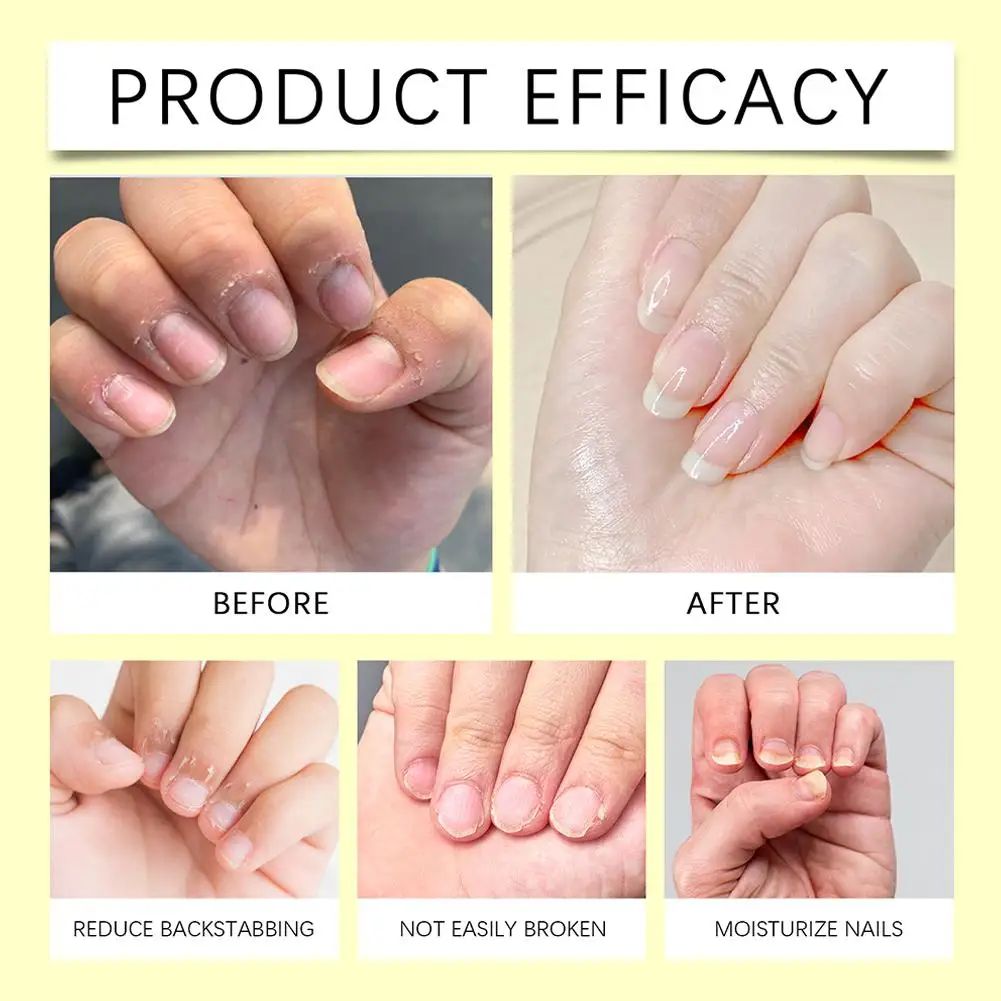 1 ชุด NAIL Repair Solution พร้อมแฟ้ม Anti-infective Paronychia Onychomycosis บํารุงเล็บ Fungal Removal GEL