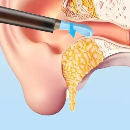 

Беспроводной умный визуальный очиститель ушей, отоскоп, инструмент для удаления ушной серы с ушным эндоскопом высокой четкости 30 Вт, инструменты для ушей, набор для ухода за здоровьем