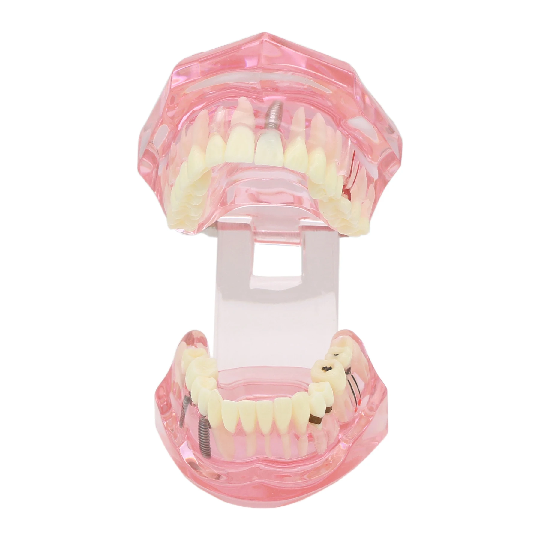 Standard Dental Model Teaching Model Implant Restoration Model For Dentistry Teaching Studying Pathology Demo