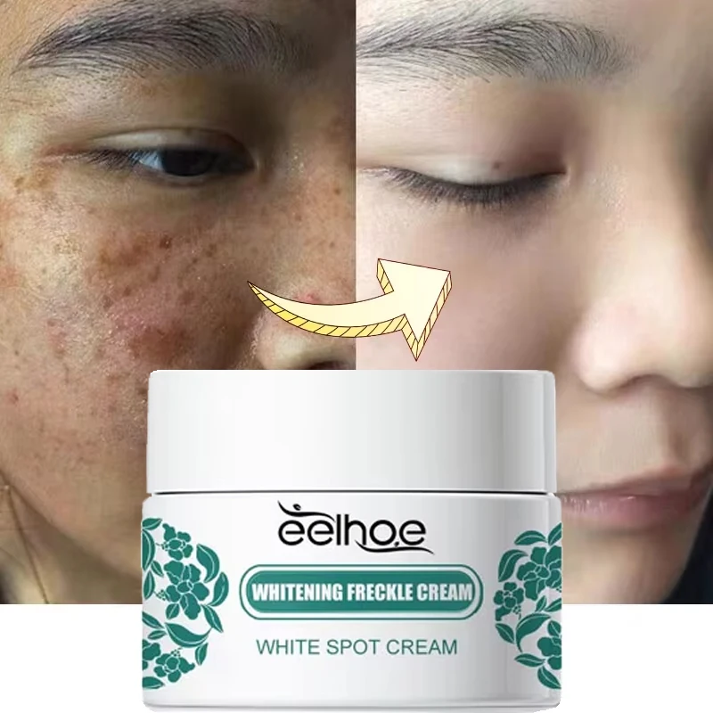 

Nicotinamide Effective Whitening Freckle Cream Remove Dark Spots Melasma Fade Melanin Anti-aging Moisturizing Brighten Skin Care