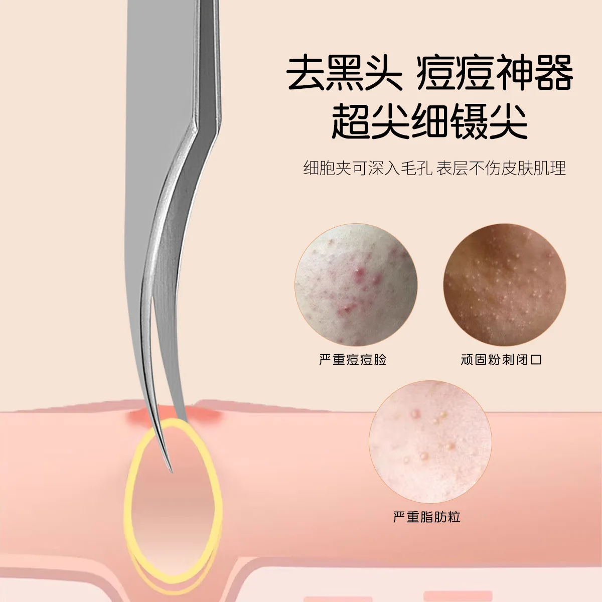 متعددة الوظائف دولفين كليب خلية البثرة كليب الملقط انتزاع دقيق مع خصائص المضادة للانزلاق صالون تجميل أدوات خاصة