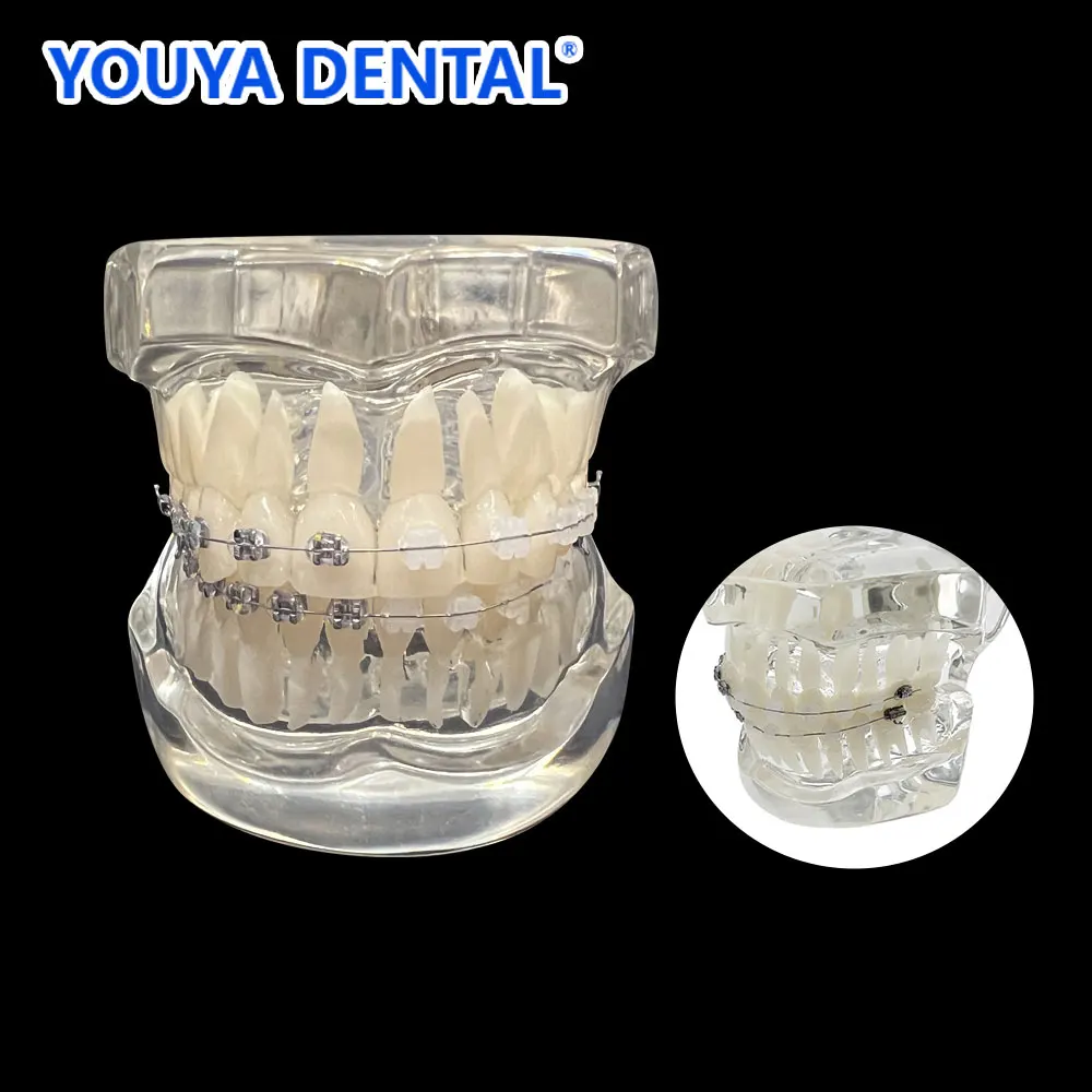 

Orthodontic Implant Gum Tooth Models Metal Ceramic Braces Resin Dentistry Dentist Material Teaching Model For Studying Teaching