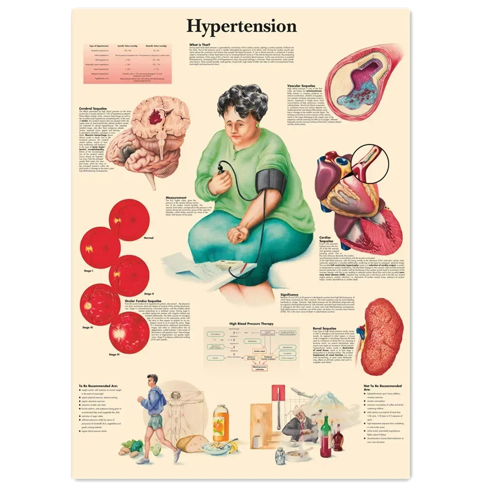 Hypertension Posters & Prints Human Anatomy Wall Art Vintage Kraft Paper Painting Wall Chart Hospital Clinic Home Decor Sticker