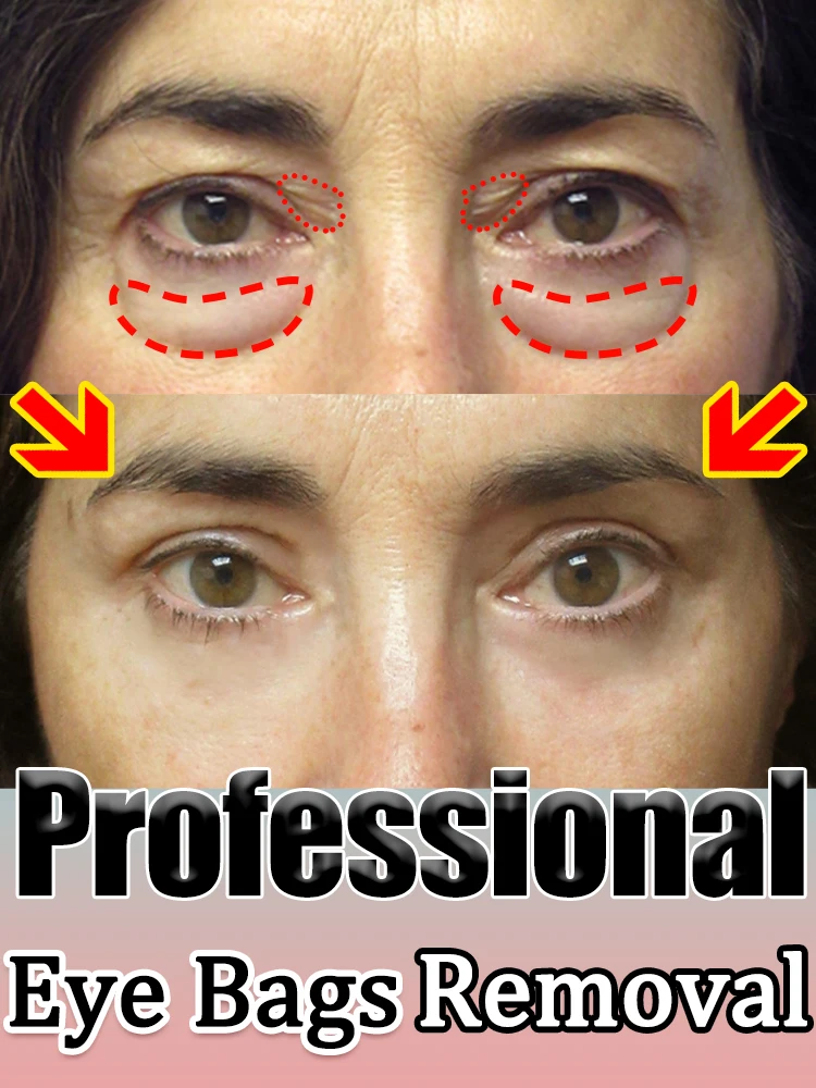 Eye problem care, dark circles and eye bags repair