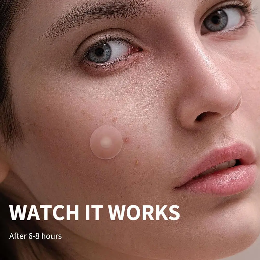 صندوق دائري من البولي ايثيلين لقع حب الشباب ثنائية اللون 360 قطعة كبيرة الحجم غير مرئية مزيج حب الشباب بقع الرؤوس السوداء والعيوب #2