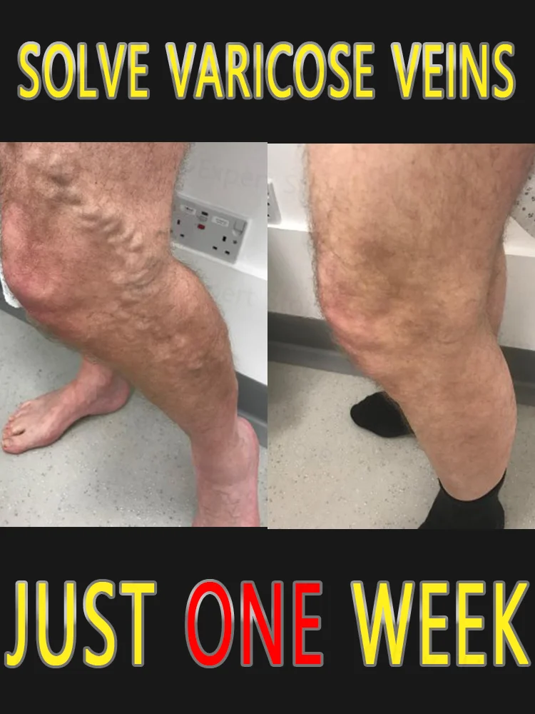 

Varicose veins