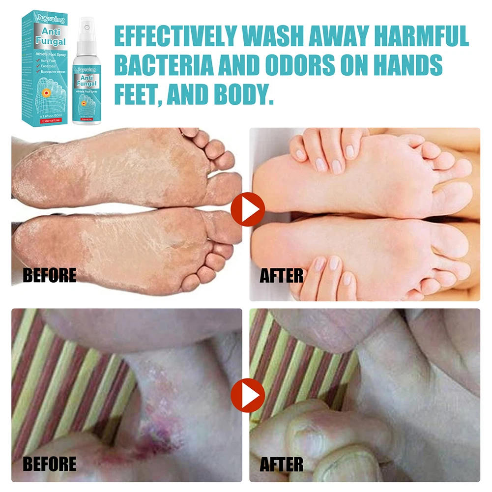 Anti Fungal Athlete Feet Spray Sterilize Infection Foot Toe Paronychia Treatment