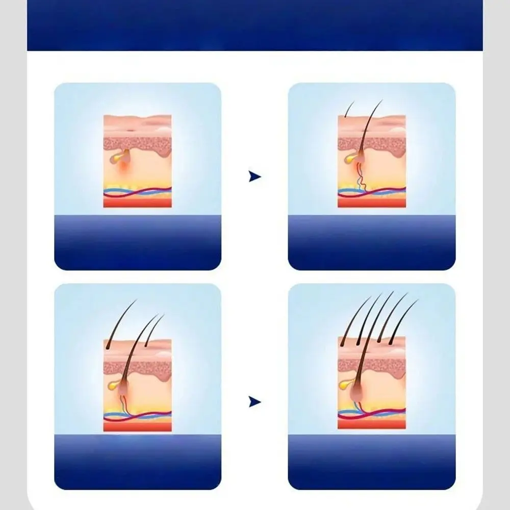 

Infrared Light Red Light Hair Loss Treatment Cap 48 LED Red Blue Light Hair Growth Device USB Charging Hair Regrowth