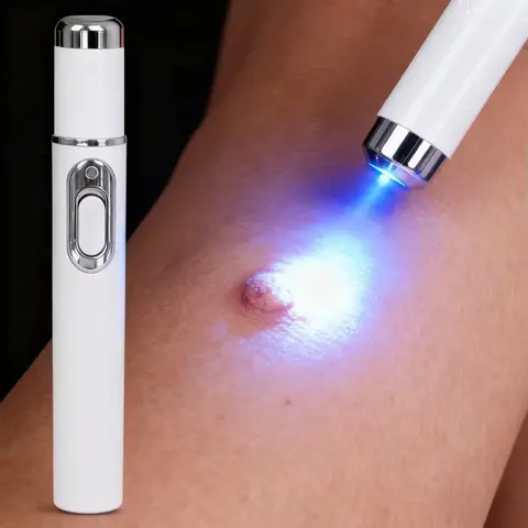 Wart Blue Light Tool, More Discounts On Sets