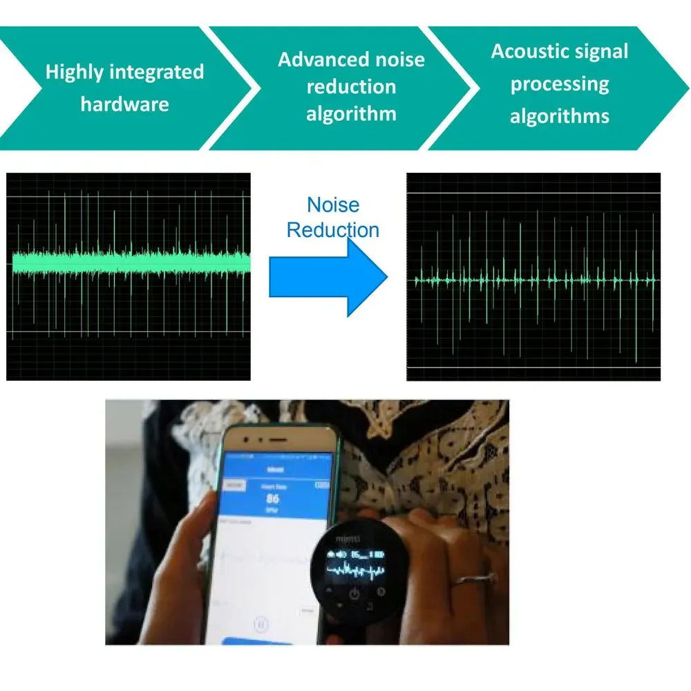 Bluetooth Digital Stethoscope, Audio Amplification, Cardiopulmonary Disease Diagnosis, Respiratory Disease, APP Display