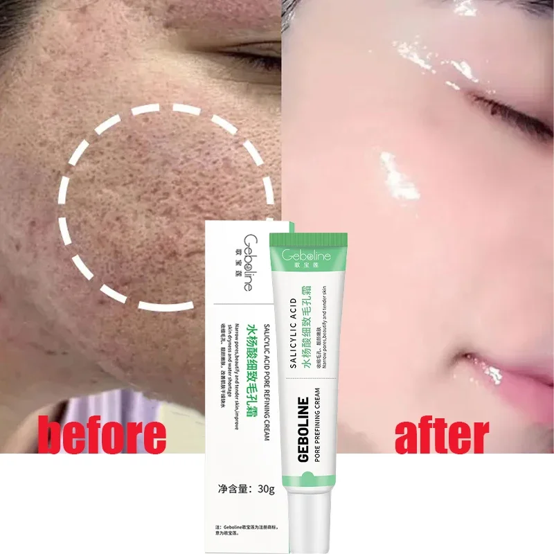 Crema retráctil de poros con ácido salicílico, elimina rápidamente los poros grandes, elimina los puntos negros, repara el estiramiento facial,