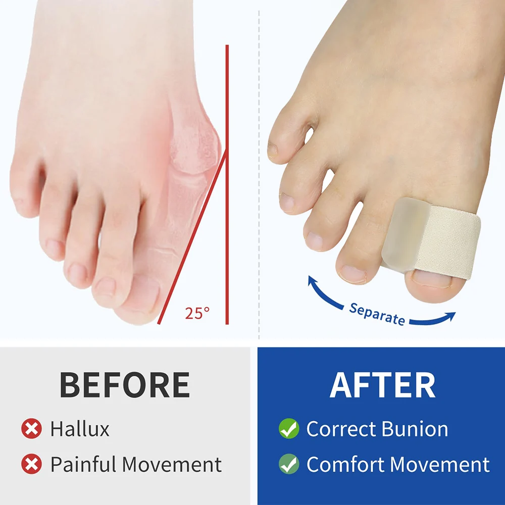 Pexmen 2/4 Stück Gel-Zehenspreizer für überlappende Zehen, große Zehenabstandshalter für Hallux-Valgus-Korrektur mit Stoßdämpfung