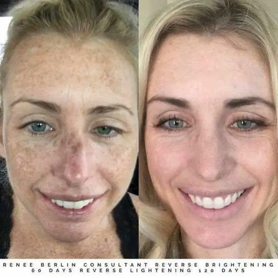 

Dark Spot Remover Melasma Chloasma Freckles Spot Removal Cream