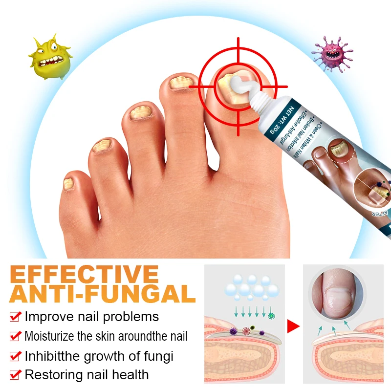 1pcs Nail Antibacterial Cream Nail Fall Off Nail Discoloration Onychomycosis Treatment Cream Toes Nail Fungus Removal Cream G048