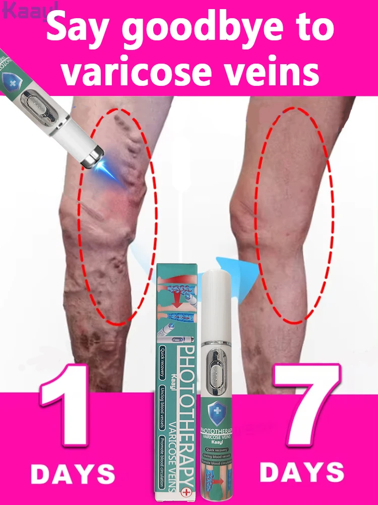 

Lampshade therapy for varicose veins Effective relief of dilated vasculitis in the legs Phlebitis Improved blood circulation