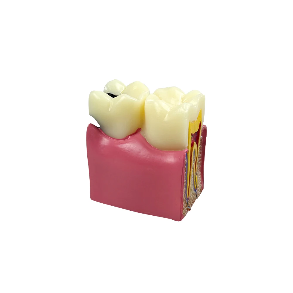 Dental Caries Comparsion Tooth Models 6 Times Study Models For Dentist Studying Teaching Anatomy Practice Dentistry Teeth Model