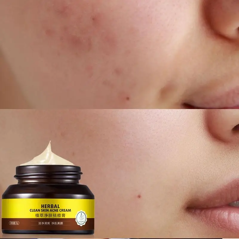 

Acne removing and acne removing acne repair and desalination of acne print cream