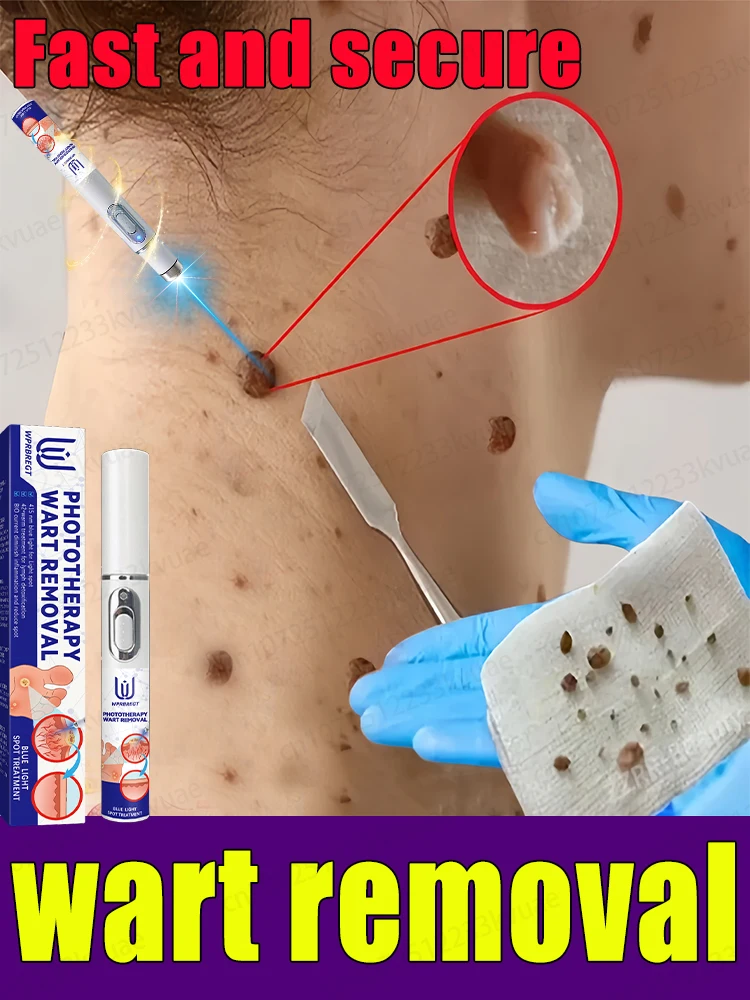 จัดการผิวอย่างปลอดภัย หมดปัญหาเรื่องหูดอีกต่อไป