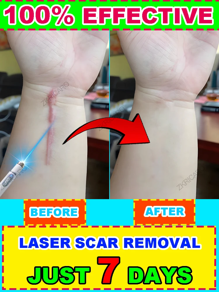 เลเซอร์พิเศษเพื่อความงามของรอยแผลเป็น |   ปากกาเลเซอร์แผลเป็น |   เหมาะสําหรับรอยแผลเป็นทุกชนิด