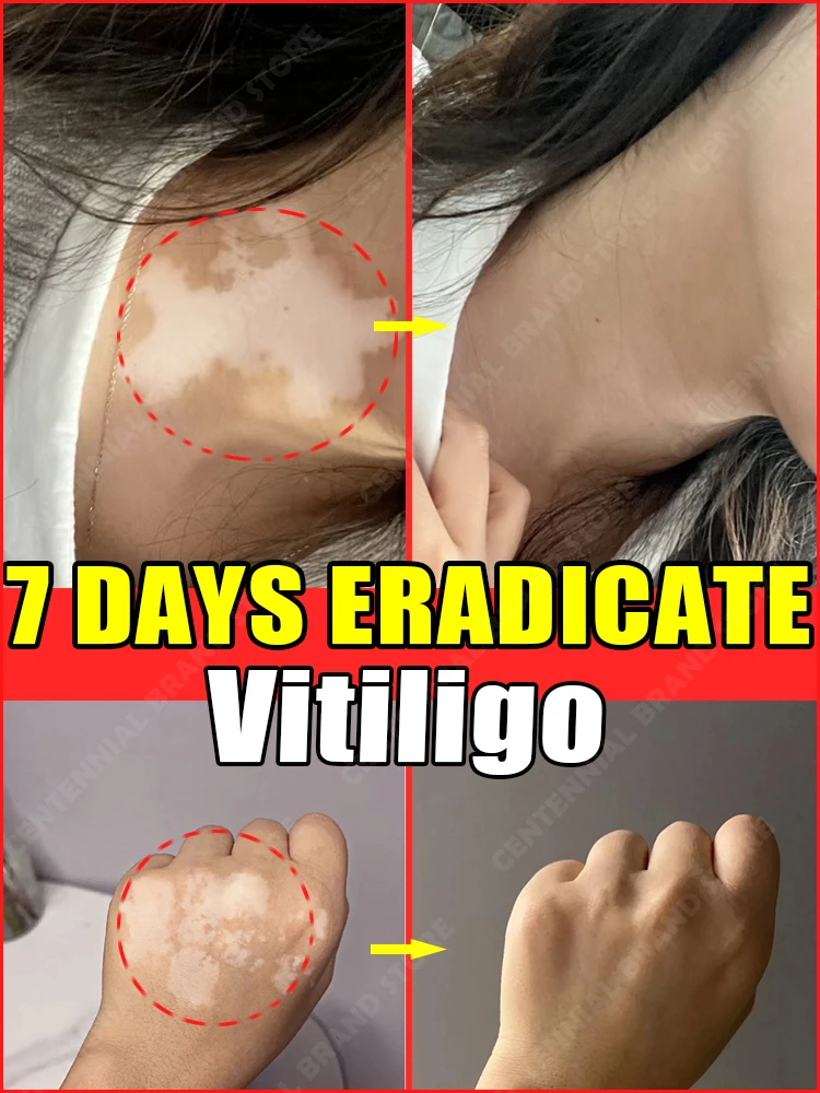 

Mitigating Vitiligo