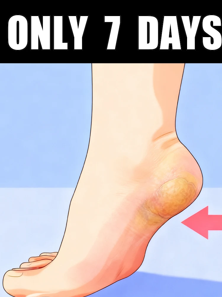 

This 7-day foot spray is suitable for athlete's foot, dry, rough, cracked feet, heels, and calluses.